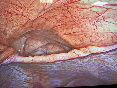 Case report: Laparoscopic nissen-sleeve gastrectomy in a young adult with incidental finding of Morgagni-Larrey hernia